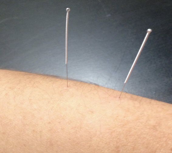 dry needling from dr lee