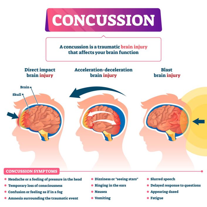 Concussion Pain Treatment - Susquehanna Spine & Rehab